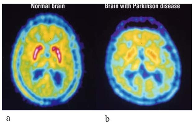 photo of brain with and without parkinsons